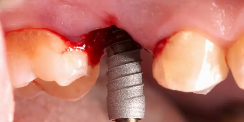 An implant being placed in a healed ridge, seen through the surgical flap