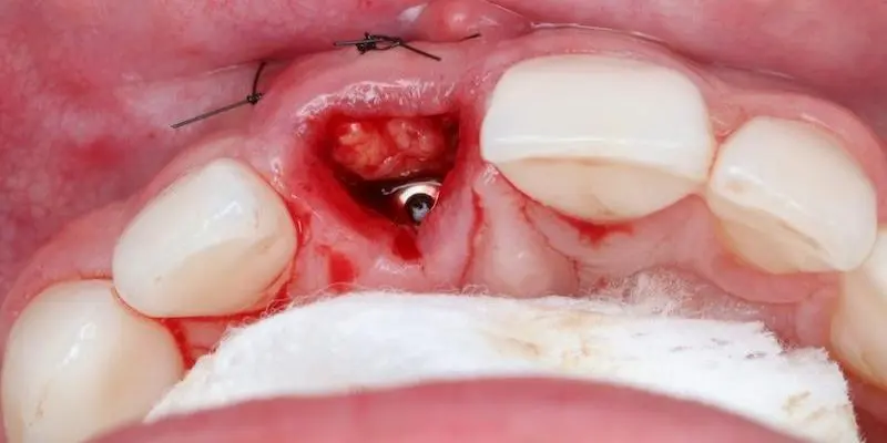 A sutured flap around an implant, with the soft tissue repositioned