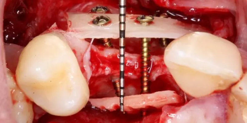 A bone block fixed with screws over the defect, the Khoury technique